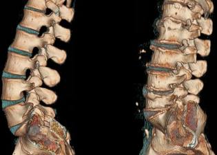 la osteocondrosis