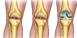 ¿qué es la osteoartritis
