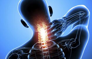 Osteocondrosis cervical