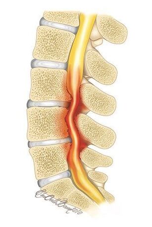 Con la osteocondrosis de la columna torácica, se produce una compresión del canal espinal.
