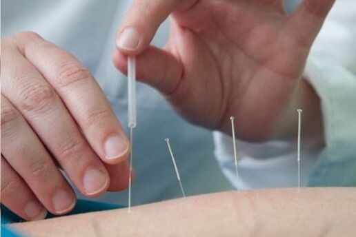 Acupuntura un método para tratar el dolor en la región lumbar causado por la osteocondrosis.