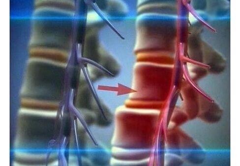 Apretar las terminaciones nerviosas en la osteocondrosis lumbar