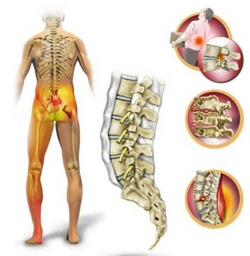 Osteocondrosis de la columna lumbar, que causa dolor de espalda.