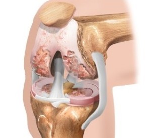 El cartílago de su rodilla