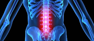 La deformación de la intervertebral disco