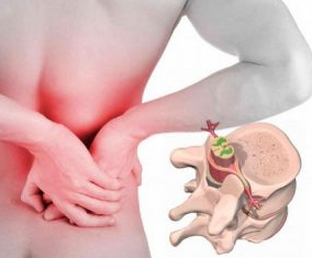 Lumbago en el comienzo de la enfermedad, de la osteocondrosis