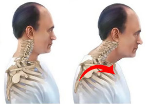 sano y enfermo de la columna vertebral