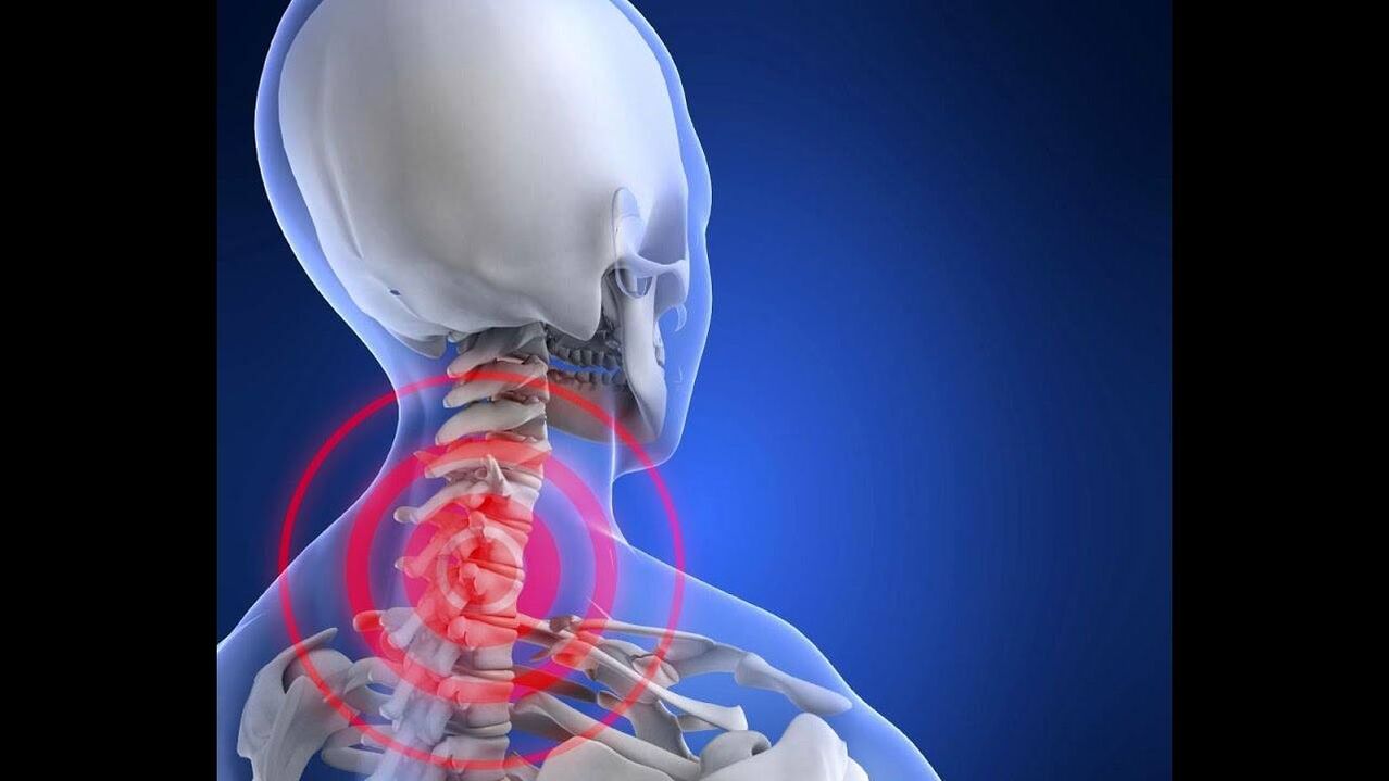 Osteocondrosis de la columna cervical