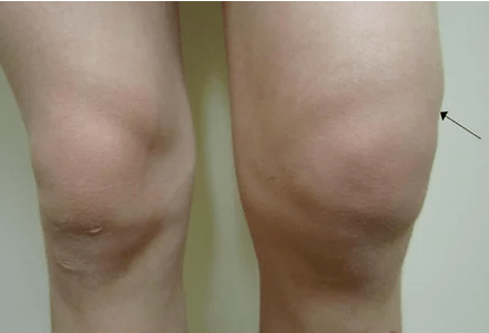 Hemartrosis de la articulación de la rodilla