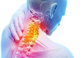 Los principales signos y síntomas de la osteocondrosis cervical