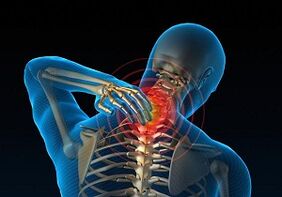 por qué se desarrolla y cómo se manifiesta la osteocondrosis cervical