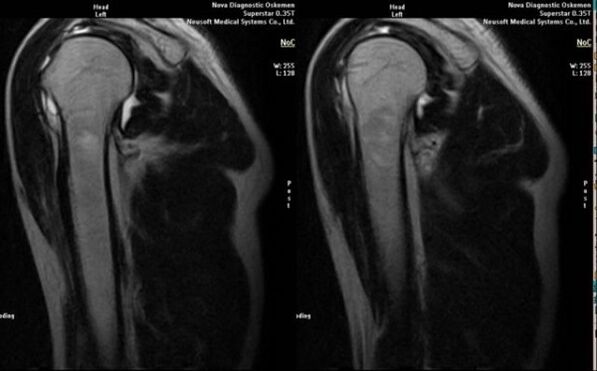 Radiografía para diagnosticar la artrosis del hombro.