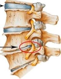 osteocondrosis de la columna cervical