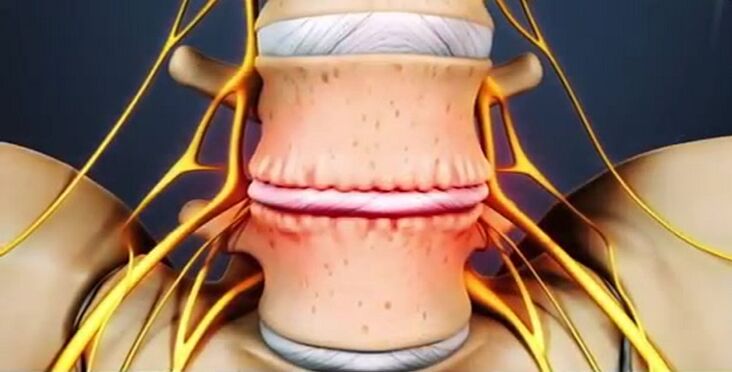 Lesiones espinales debido a la osteocondrosis.